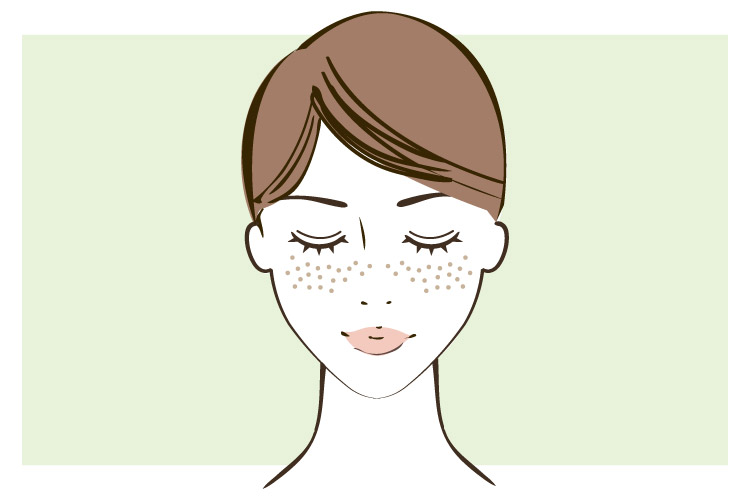 そばかす（雀卵斑）