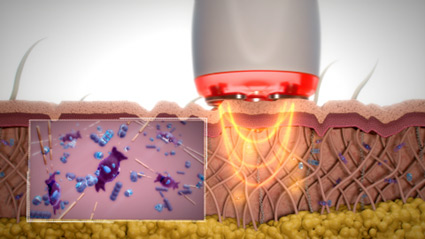 RF（ラジオ波）治療とは