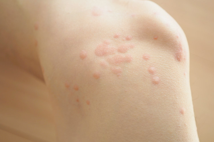 蕁麻疹（じんましん）