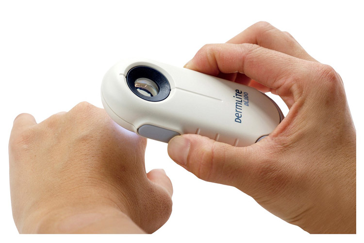 ダーモスコピー